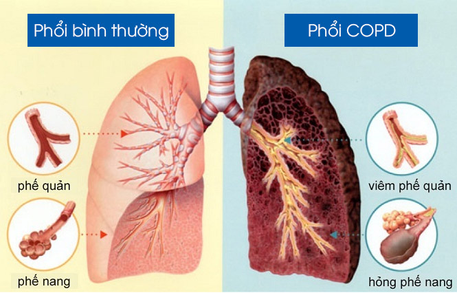 kiến thức bệnh phổi tắc nghẽn mãn tính COPD